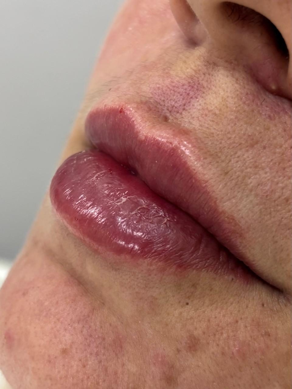 preechimentolabial